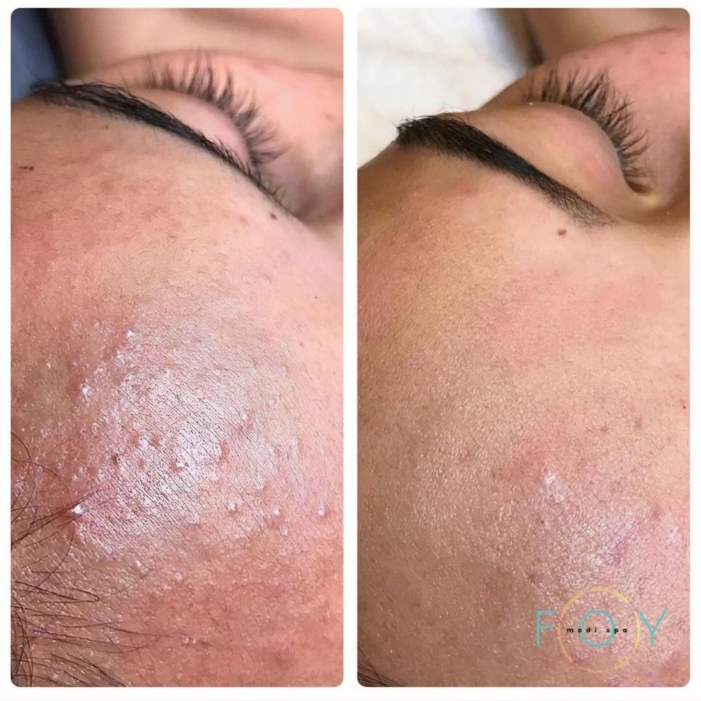 AHA + BHA Dermal Night Treatment