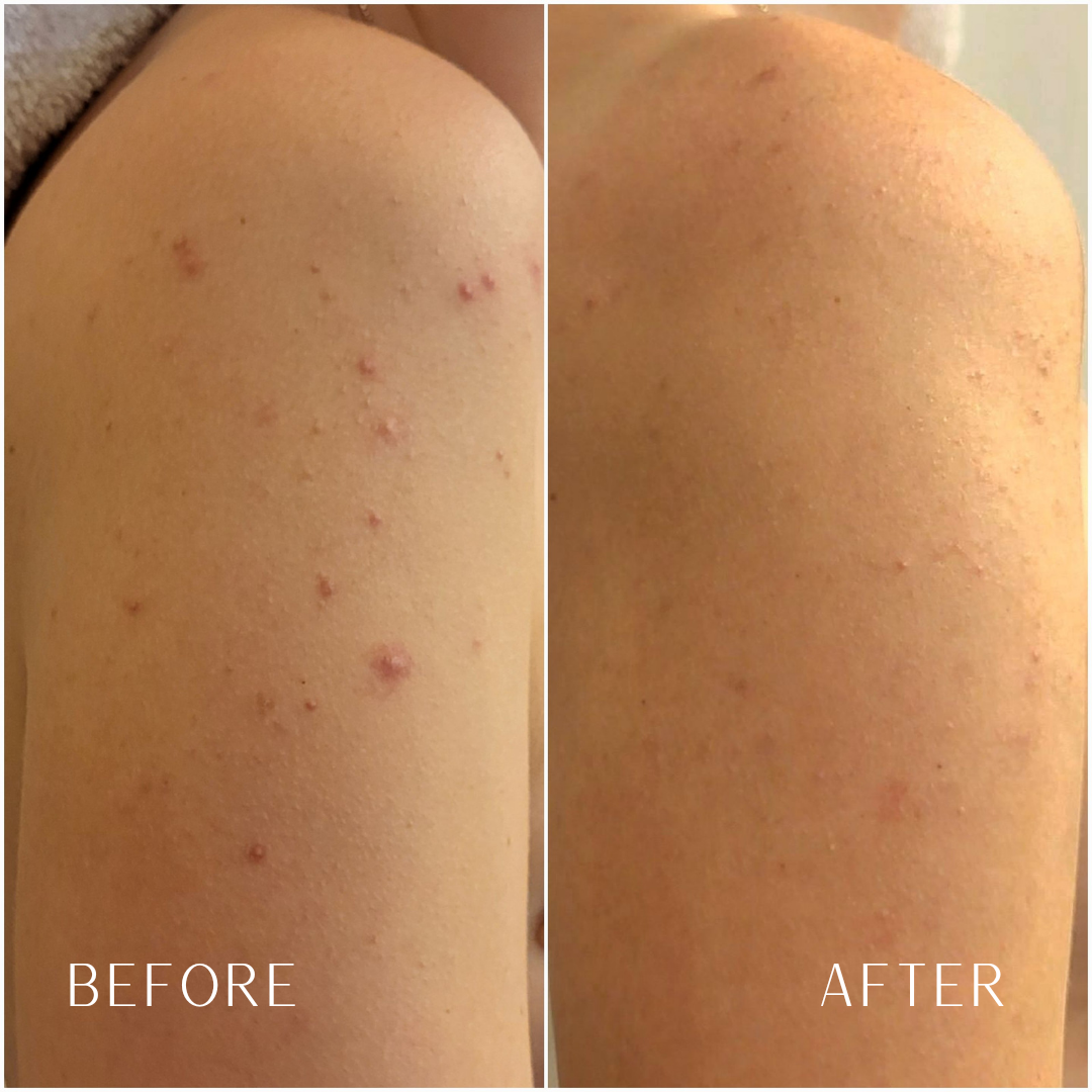 Enzymatic Dermal Polish- Textured Enzyme Treatment