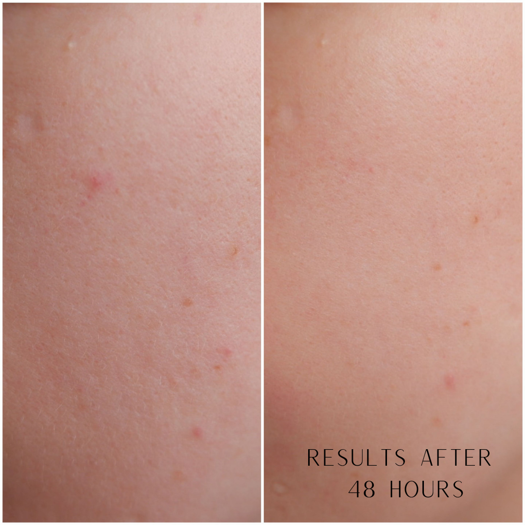 Enzymatic Dermal Polish- Textured Enzyme Treatment