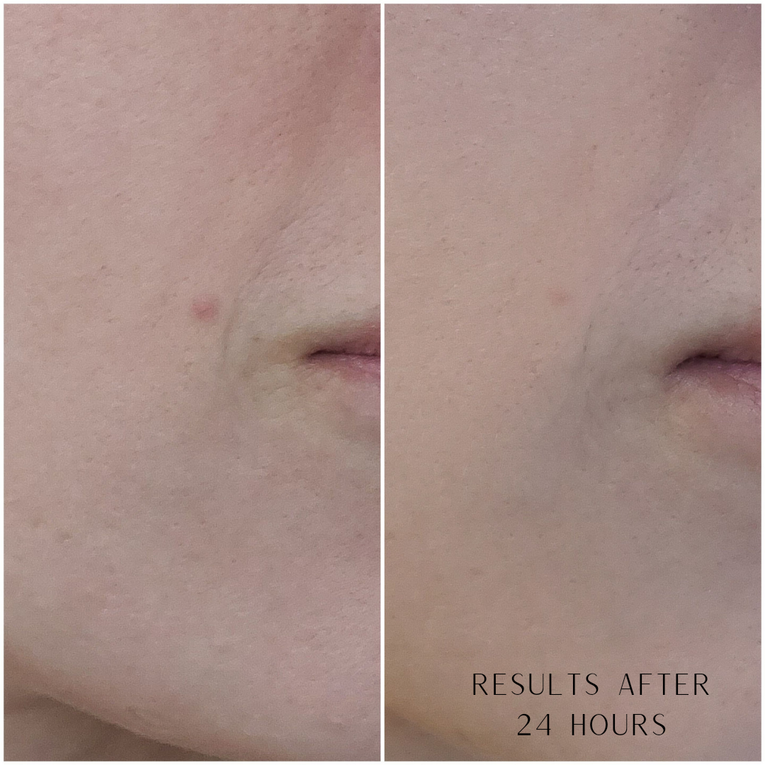 Enzymatic Dermal Polish- Textured Enzyme Treatment