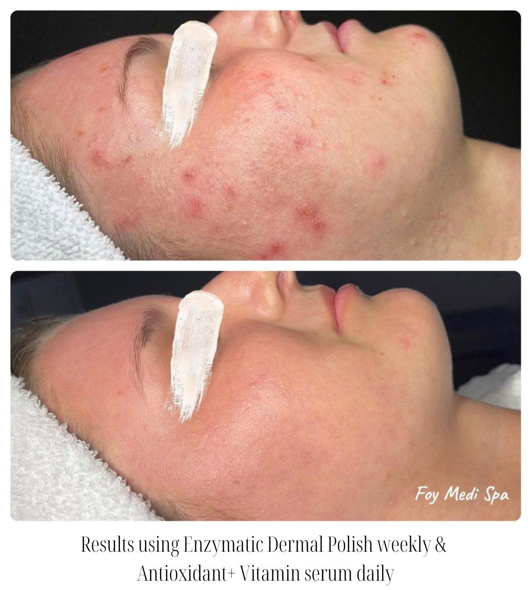 Enzymatic Dermal Polish- Textured Enzyme Treatment